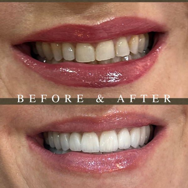 CARILLAS PARA UNA SONRISA NATURALMENTE ELEGANTE - Imagen 2